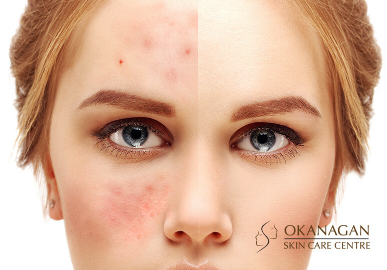Understanding Rosacea And Your Options For Treatment